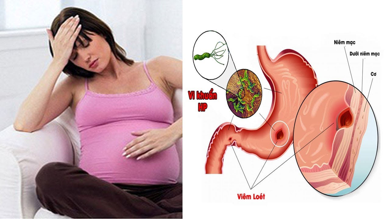 Bị đau dạ dày khi mang thai phải điều trị thuốc có ảnh hưởng đến thai nhi?
