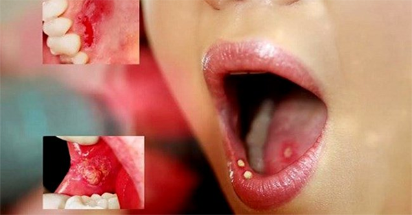 NHỮNG THÔNG TIN gì bạn NÊN và CẦN BIẾT về bệnh ung thư răng miệng
