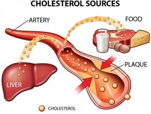 Cholesterol là gì và bệnh cholesterol cao