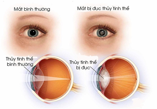 ĐỤC THỦY TINH THỂ, căn bệnh dễ gây mù lòa ở người cao tuổi