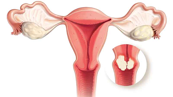 CHUYÊN GIA CHIA SẺ: Bệnh ung thư cổ tử cung giai đoạn đầu, 2 và 3