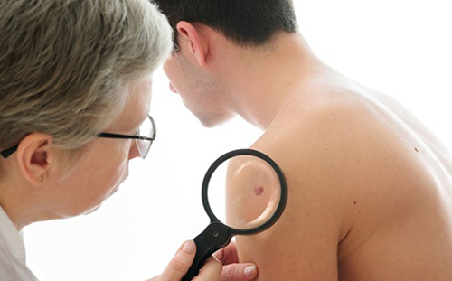 TỔNG HỢP những THÔNG TIN CƠ BẢN nhất bạn nên biết về bệnh ung thư da