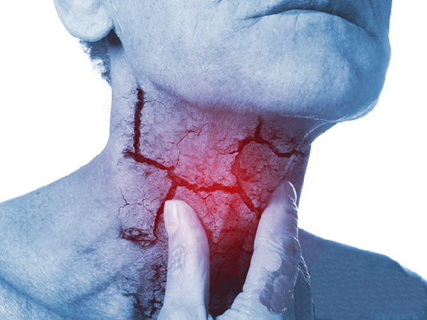 CẢNH BÁO độ nguy hiểm từ dấu hiệu triệu chứng bệnh ung thư cuống họng