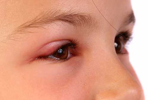 Bệnh ung thư mắt không phổ biến nhưng vô cùng nguy hiểm