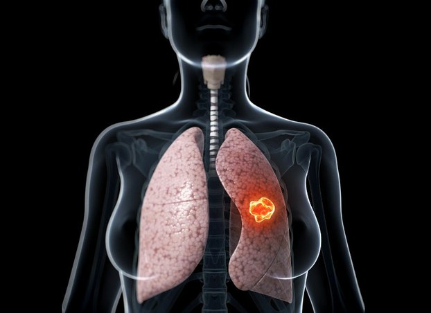 Những lưu ý đối với bệnh nhân mắc ung thư phổi giai đoạn cuối