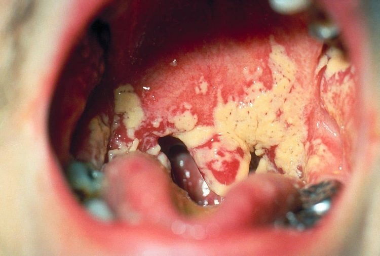 Nấm Candida miệng (Nấm miệng, nấm lưỡi, tưa lưỡi)