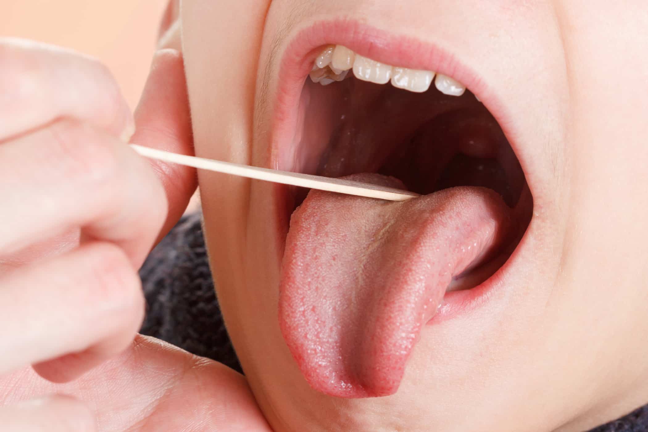 8 nguyên nhân gây đau họng một bên mà bạn cần biết
