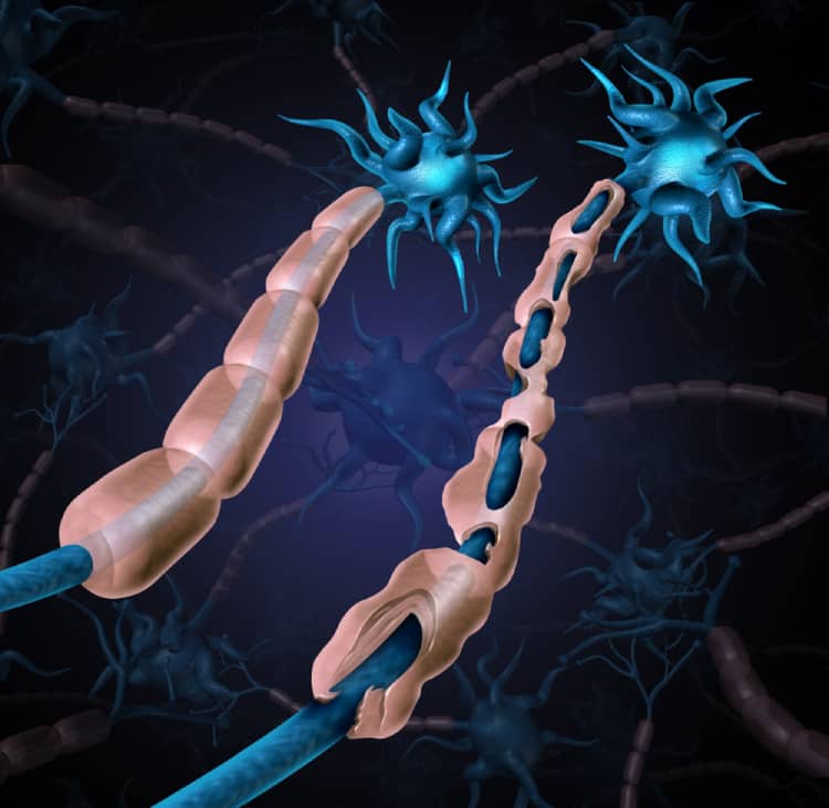 Viêm đa dây thần kinh hủy myelin mạn tính (CIDP)