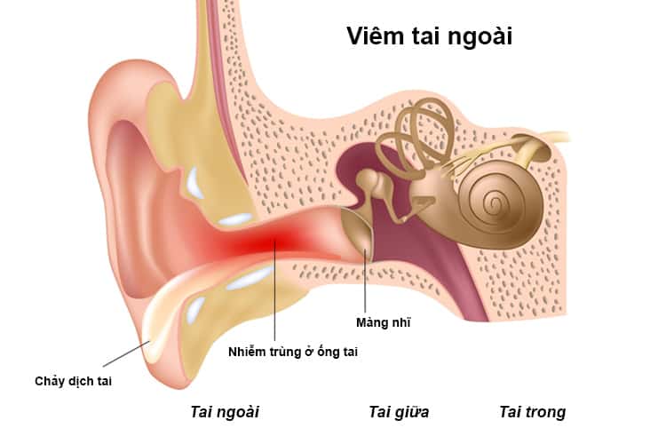 Mách bạn 7 cách chữa viêm tai ngoài tại nhà hay và dễ áp dụng