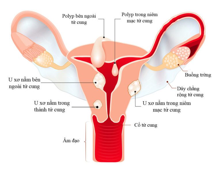 Ảnh hưởng của u xơ tử cung đến quá trình mang thai và sinh nở