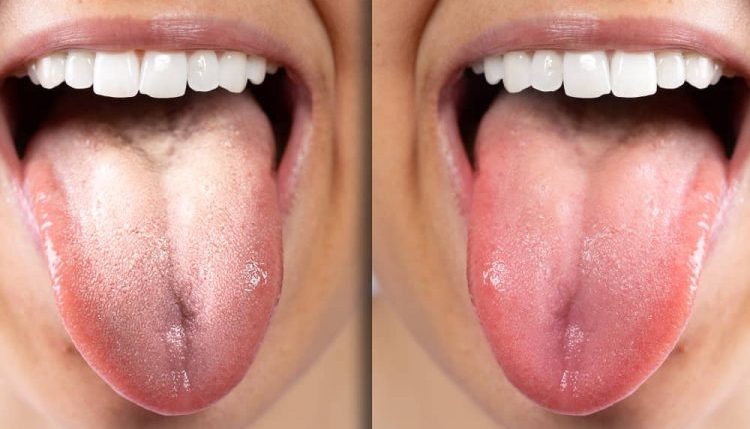 Lưỡi trắng là bệnh gì? Làm sao để điều trị hiệu quả?