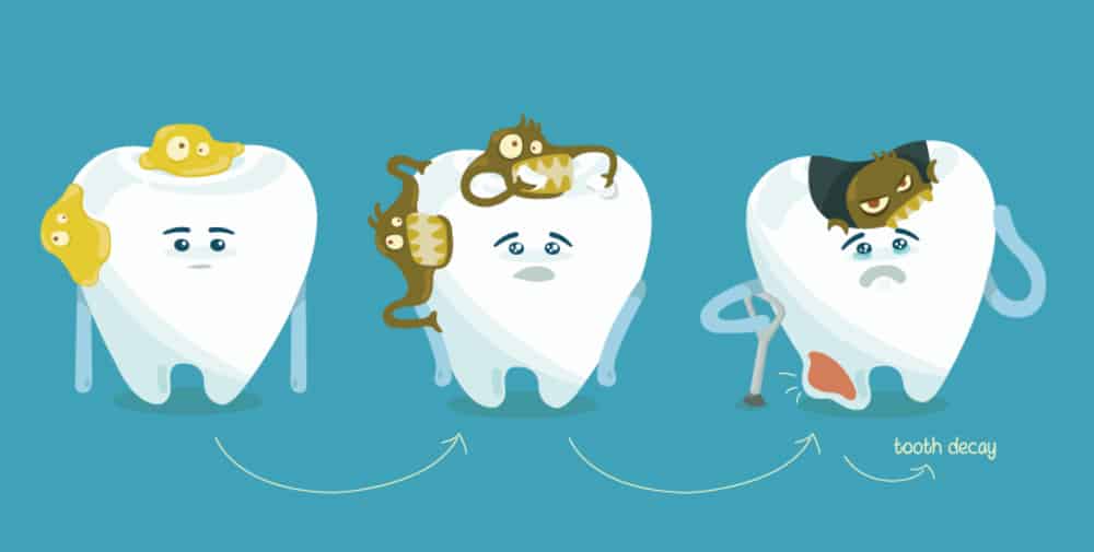 Răng khôn có thể bị sâu không? Lý do và cách xử lý