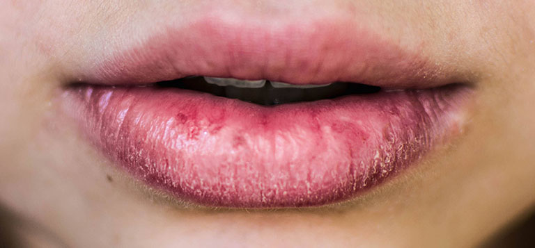 Chàm môi – Bệnh lý phiền toái và cách trị dứt điểm