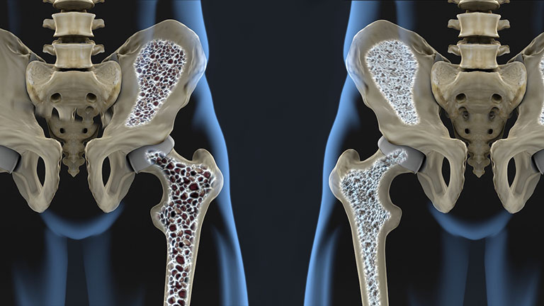 Bệnh loãng xương: Nguyên nhân, dấu hiệu nhận biết và điều trị