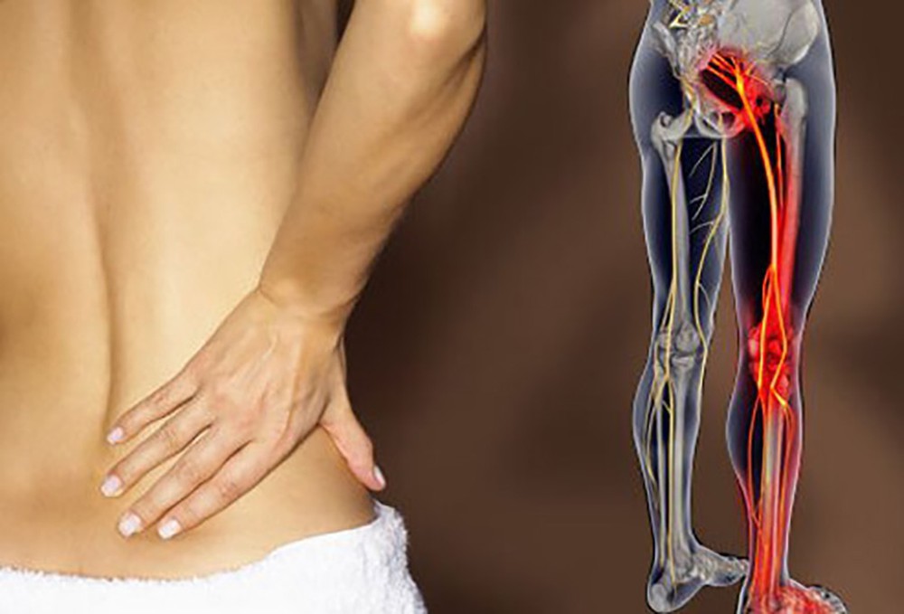 Đau lưng dưới gần mông ở phụ nữ là bệnh gì và cách giảm đau