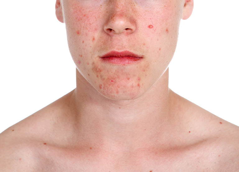 Dị ứng da mặt: Nguyên nhân, biểu hiện và cách xử lý