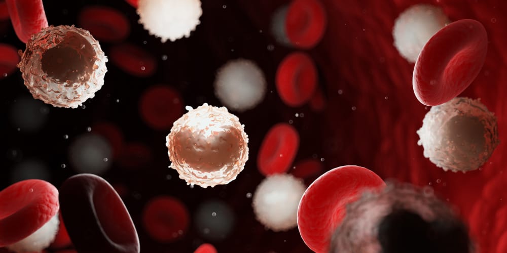 Ung thư máu – Bệnh bạch cầu mãn tính dòng lympho