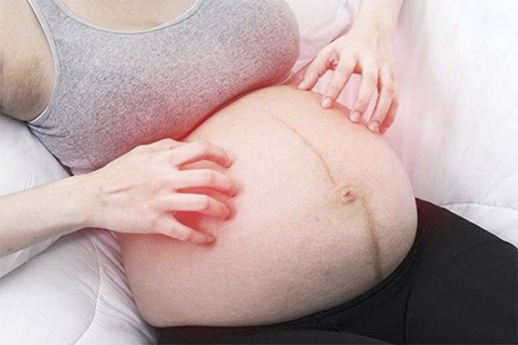 Nổi mề đay khi mang thai có gây nguy hiểm không? Cách điều trị bệnh