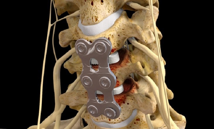 Phẫu thuật thoát vị đĩa đệm cột sống thắt lưng có an toàn không? Các phương pháp chính