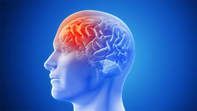 Thiếu máu não: Nguyên nhân, dấu hiệu nhận biết và điều trị