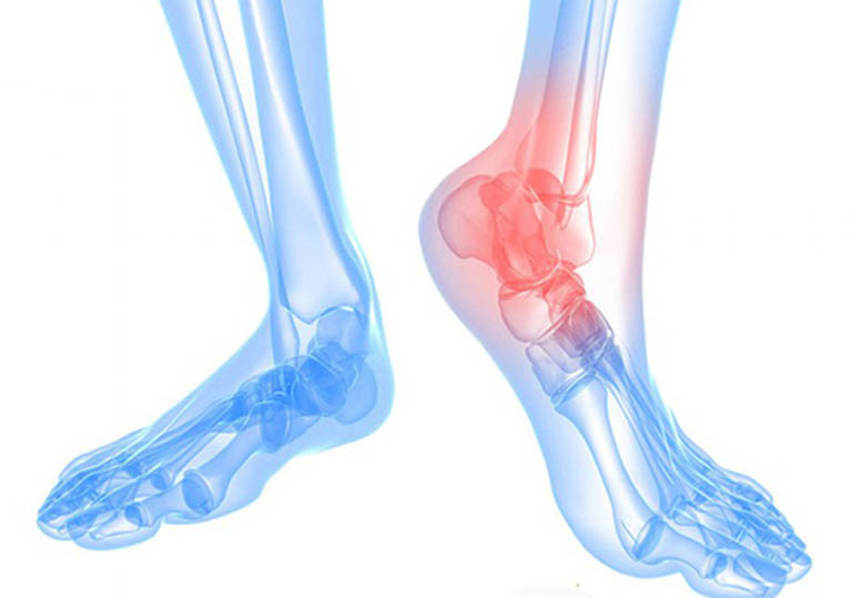 Thoái hóa khớp cổ chân: Nguyên nhân và cách chữa trị