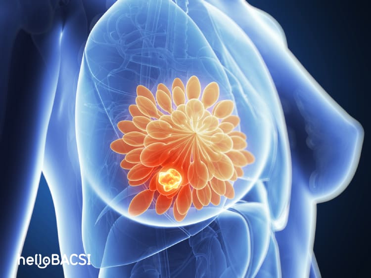 Ung thư vú giai đoạn 2 sống được bao lâu?