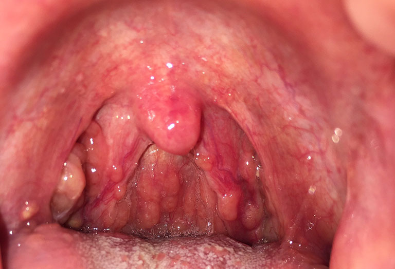 Viêm họng mạn tính quá phát – Dấu hiệu & cách điều trị