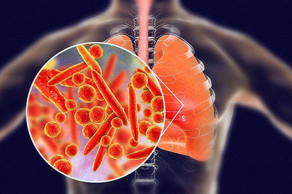 Viêm phổi có lây không, lây nhiễm qua đường nào và có dễ lây không?
