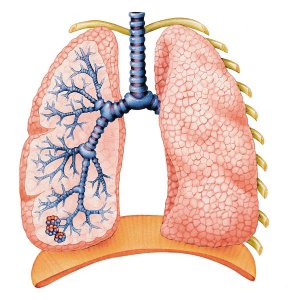 Triệu chứng và cách chữa trị bệnh lao phổi