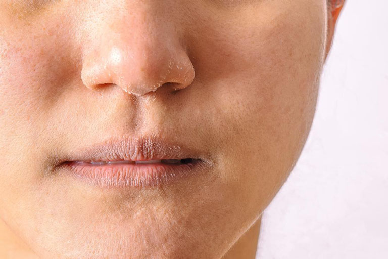 Bệnh chàm môi: Nguyên nhân, biểu hiện, cách điều trị