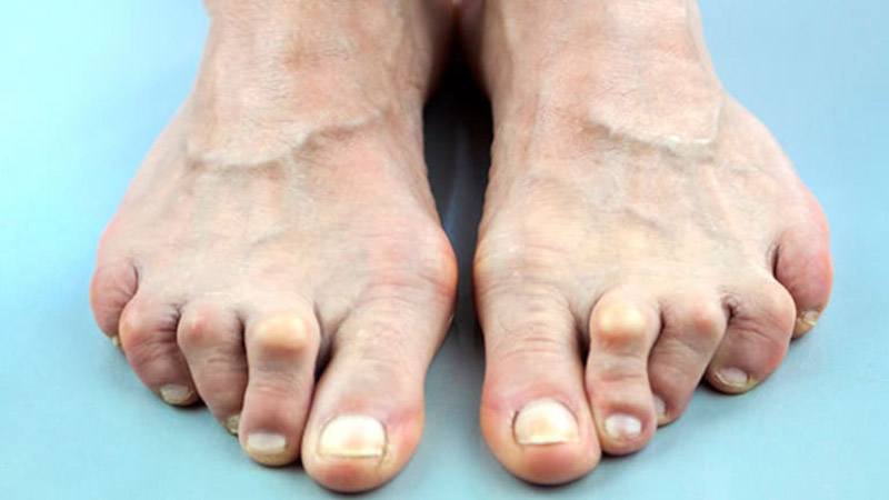 Bệnh viêm khớp bàn chân: Nguyên nhân, dấu hiệu và cách điều trị 