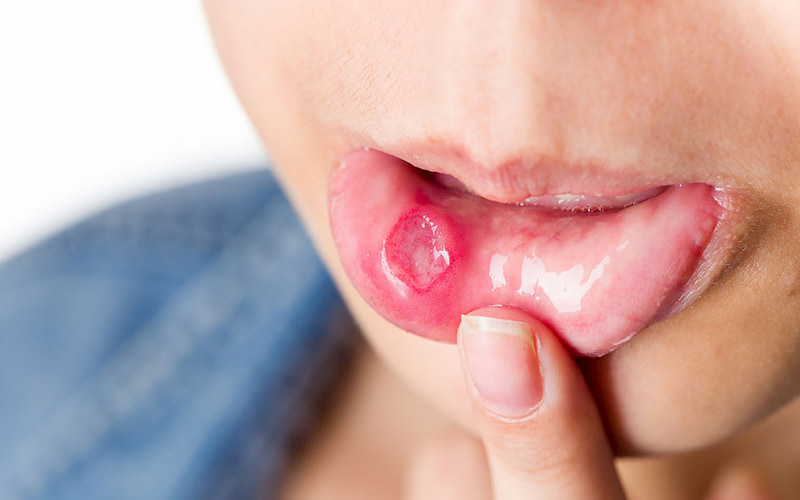 15 cách chữa nhiệt miệng hiệu quả nhất dành cho bạn