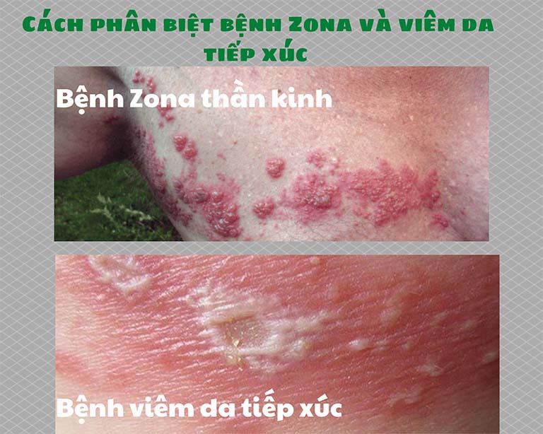 Cách phân biệt bệnh Zona và viêm da tiếp xúc