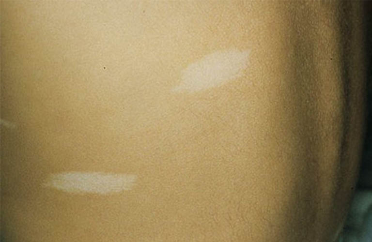 Nổi đốm trắng trên da: Dấu hiệu cảnh báo 7 căn bệnh có thể mắc phải