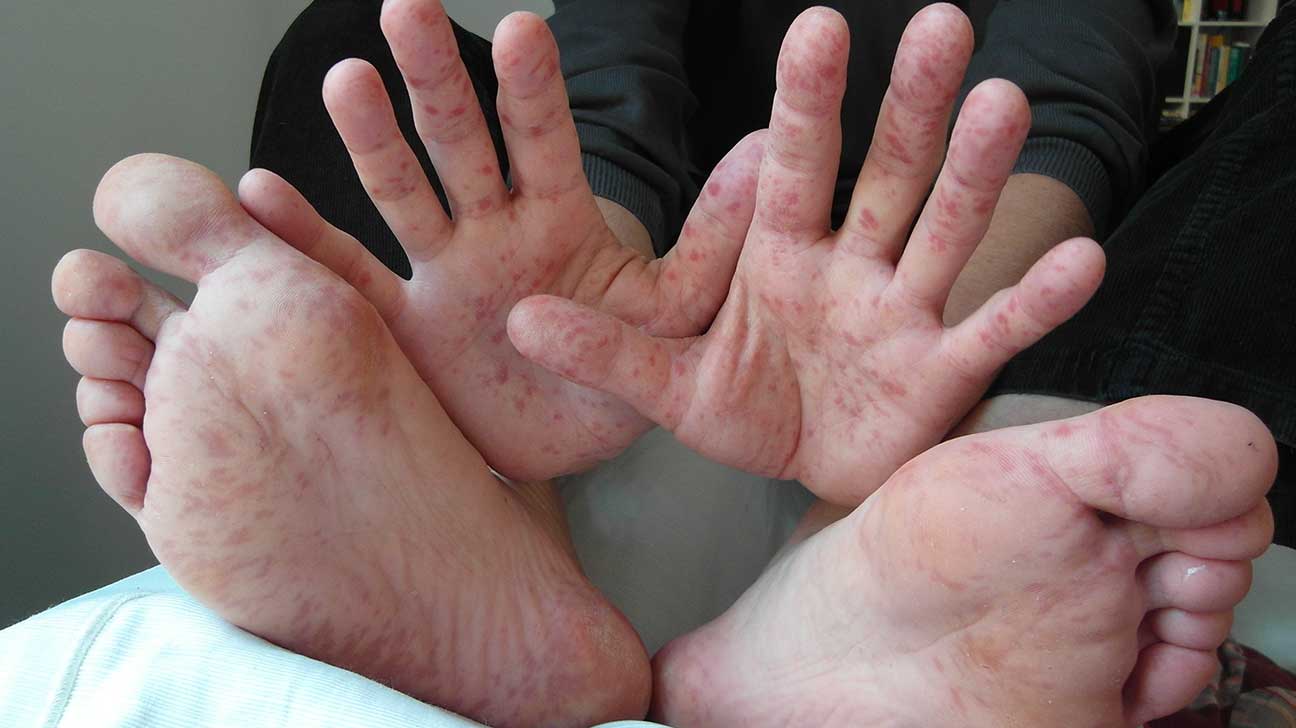 Bị dị ứng da bàn tay bàn chân do đâu? Điều trị thế nào?