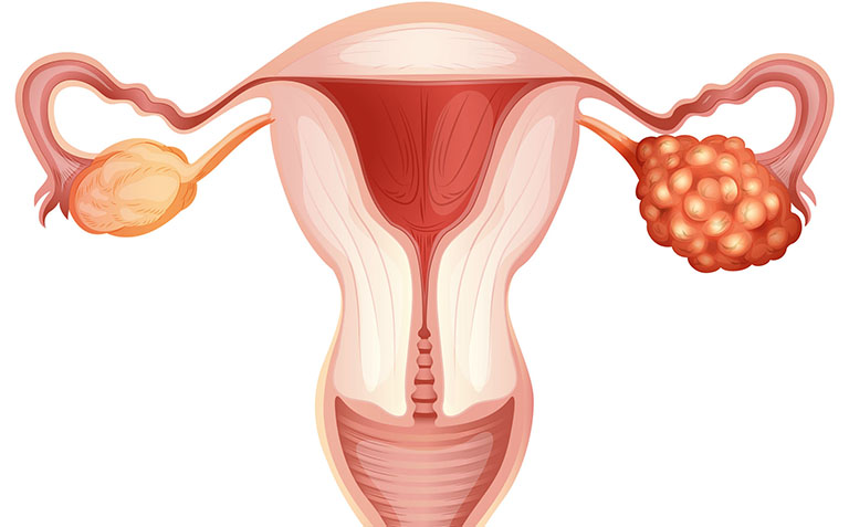 Các giai đoạn ung thư buồng trứng – Điều cần biết