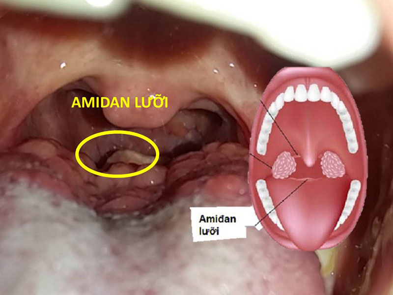 Amidan lưỡi là gì? Cách nhận biết triệu chứng và điều trị hiệu quả