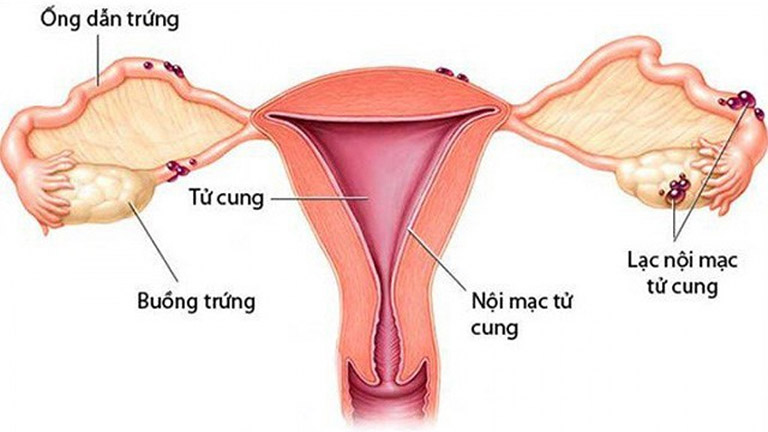 Lạc nội mạc tử cung là gì? Dấu hiệu, cách điều trị