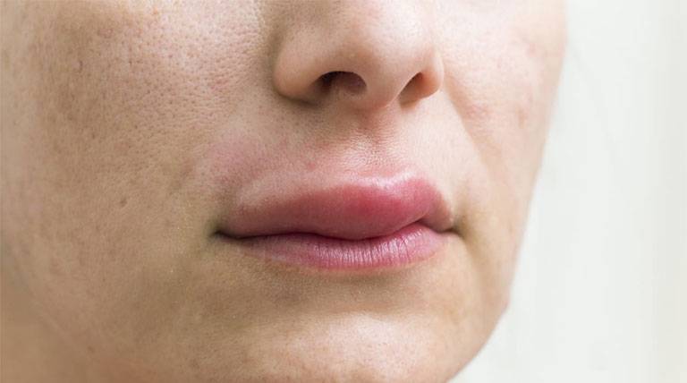 Ngủ dậy bị sưng môi: Nguyên nhân, cách khắc phục, phòng ngừa