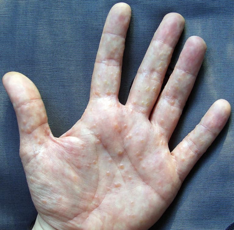 Nổi mụn nước ngứa ở tay là bệnh gì? Cách điều trị hiệu quả