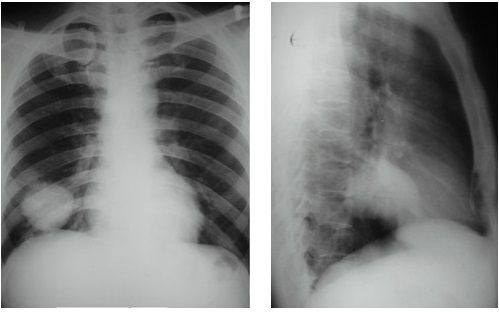 Nốt mờ ở phổi biểu hiện của bệnh gì?