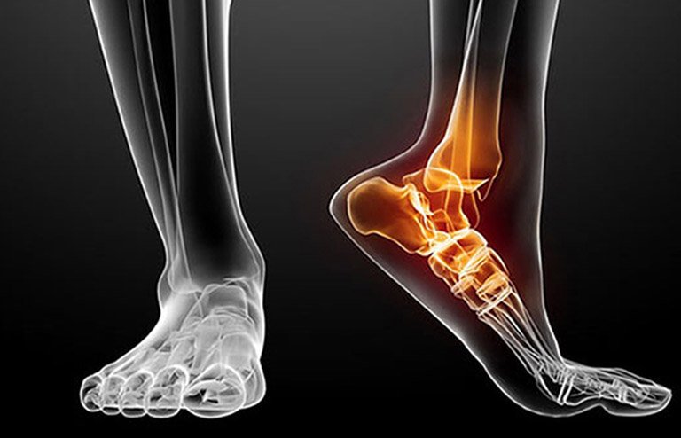 Thoái hóa khớp cổ chân: Dấu hiệu nhận biết và cách điều trị