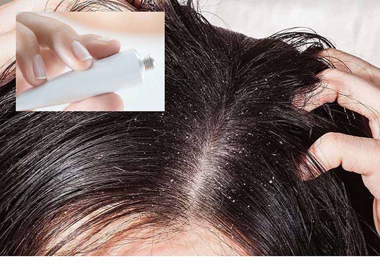 4 loại thuốc bôi trị nấm da đầu phổ biến, nhiều người sử dụng