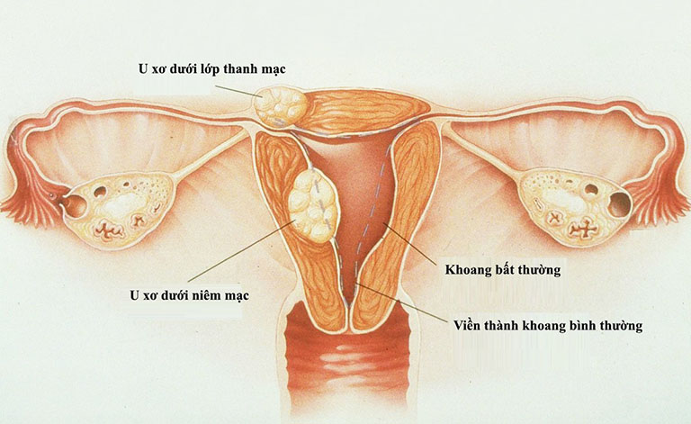 U xơ tử cung là gì? Dấu hiệu, chẩn đoán và điều trị