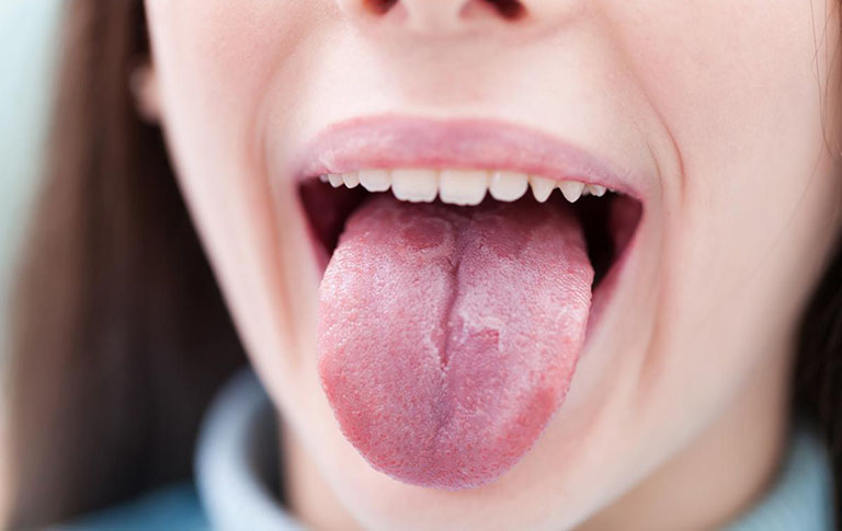 Ung thư lưỡi giai đoạn 1: Dấu hiệu, cách chữa trị
