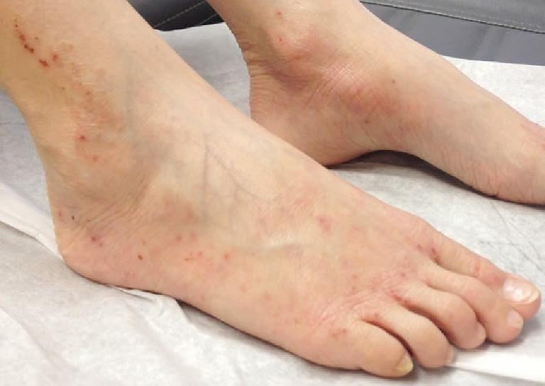 Bệnh viêm da cơ địa ở chân: Cách nhận biết và điều trị ngăn tái phát đến 95%