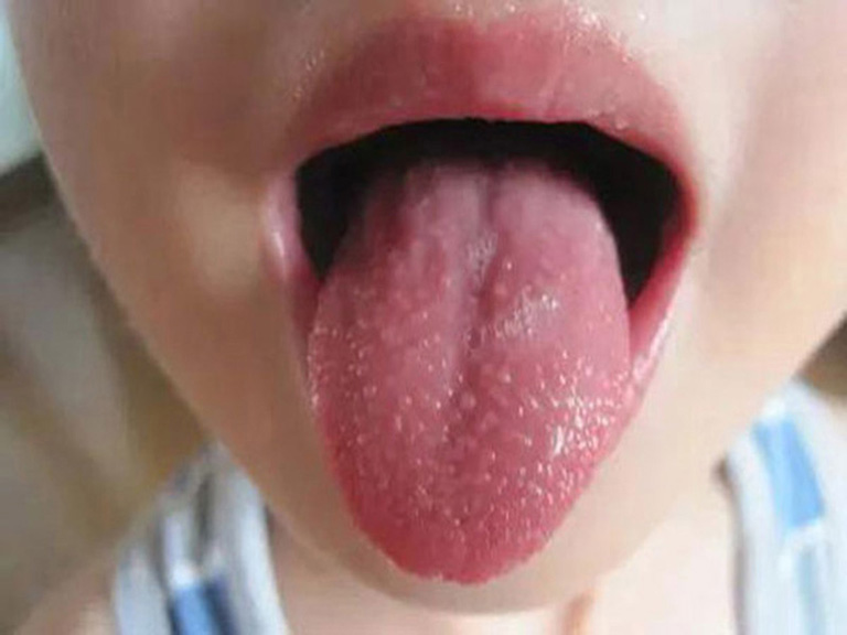 Viêm họng hạt ở lưỡi: Dấu hiệu nhận biết và điều trị