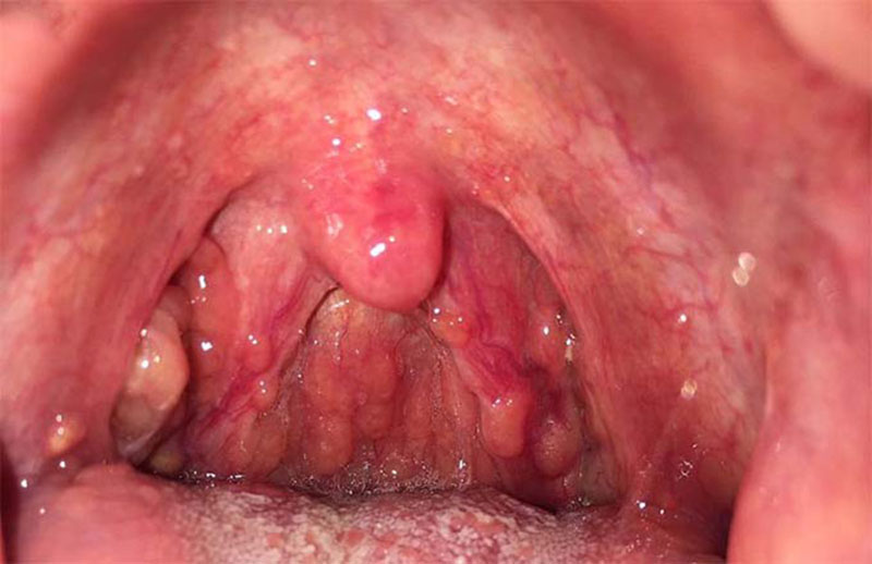 Viêm họng hạt: Nhận biết triệu chứng điển hình, nguyên nhân và cách chữa nhanh nhất