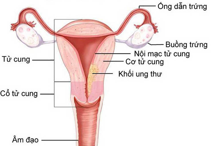 Viêm nội mạc tử cung: Nguyên nhân, triệu chứng, điều trị