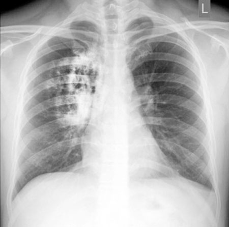 Bệnh phổi trắng là gì? Cách điều trị bệnh hiệu quả